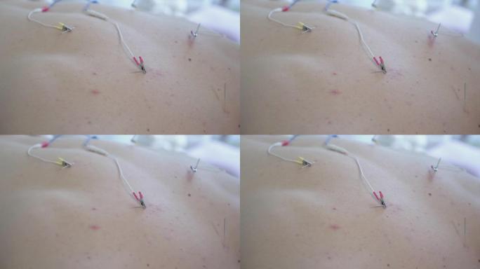 用插入的针灸针和连接的电气设备对男性高加索人背部进行特写。无法识别的人的电针。肌肉疼痛的愈合，替代疗