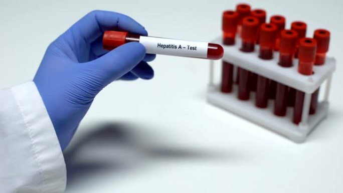 甲型肝炎，医生在试管中显示血样，实验室研究，健康检查