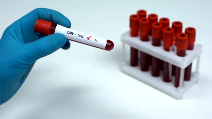 CMV检测阴性，医生检查血样，实验室研究，健康检查