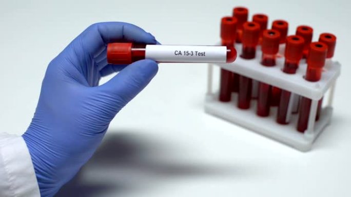 CA 15-3，医生在试管中显示血液样本，实验室研究，健康检查