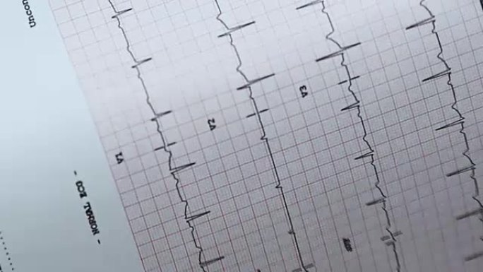心电图体检心脏病