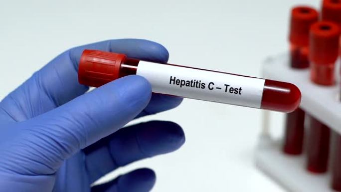 丙型肝炎-测试，医生在试管中保存血液样本特写，健康检查