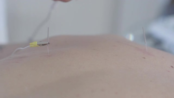女性手将电连接到男性背部的针。无法识别的高加索针灸师使用电针治疗疼痛的特写。专业知识，替代医学。