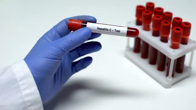 丙型肝炎，医生在试管中显示血样，实验室研究，健康检查