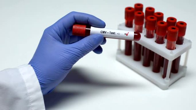 CMV检测阳性，医生检查血样，实验室研究，健康检查