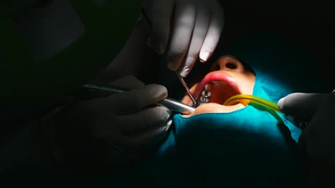 牙医治疗牙齿女人矫正修复国外外国人老外拔