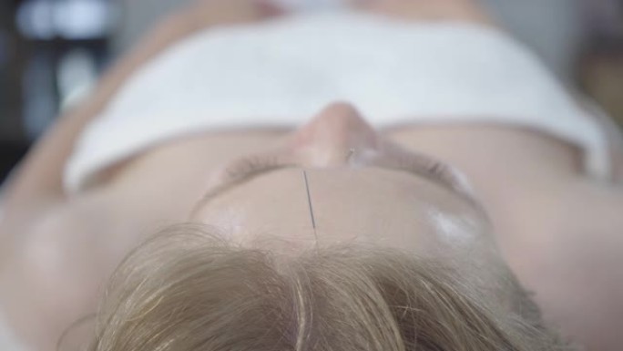 插入针头的女性头皮特写。用针灸疗法射击年轻的白人金发女子的头部。中医概念。