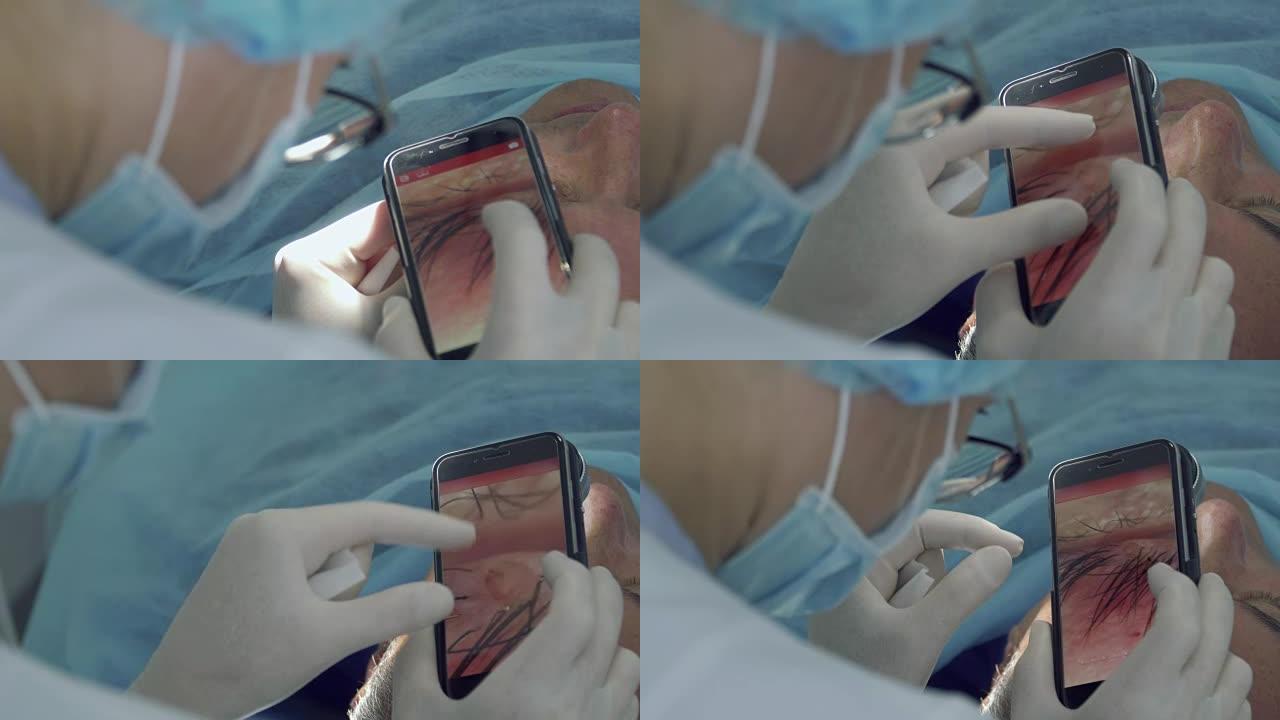 皮肤科医生在手机上制作胎记的宏观照片