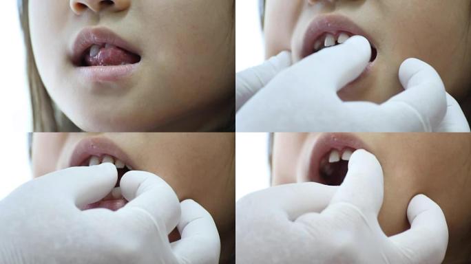 牙医用手套检查小女孩的牙齿以摆动松动的牙齿