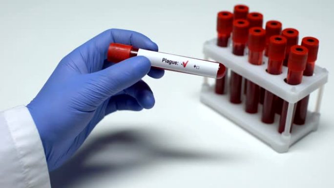 鼠疫试验阴性，医生在试管中显示血样，健康检查
