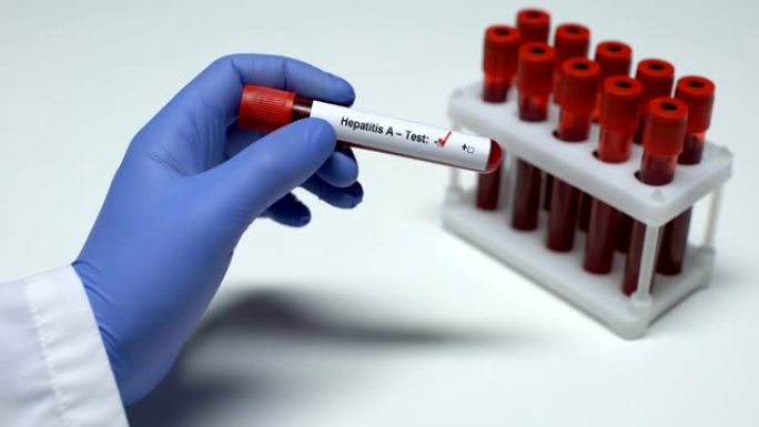 甲型肝炎检测阴性，医生在试管中显示血样，健康检查