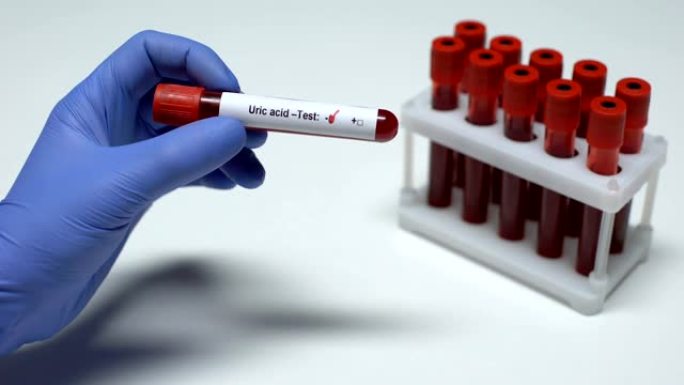 尿酸测试阴性，医生显示血样，实验室研究，健康检查