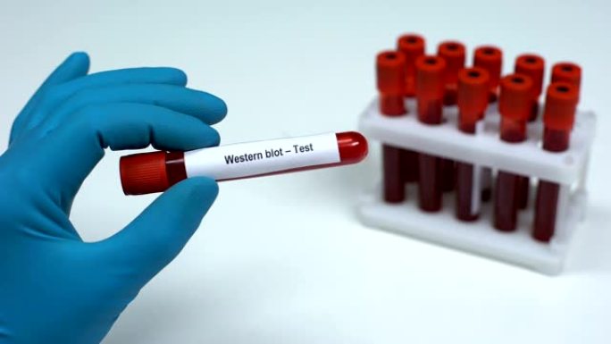 Western blot，医生在试管中显示血液样本，实验室研究，健康检查