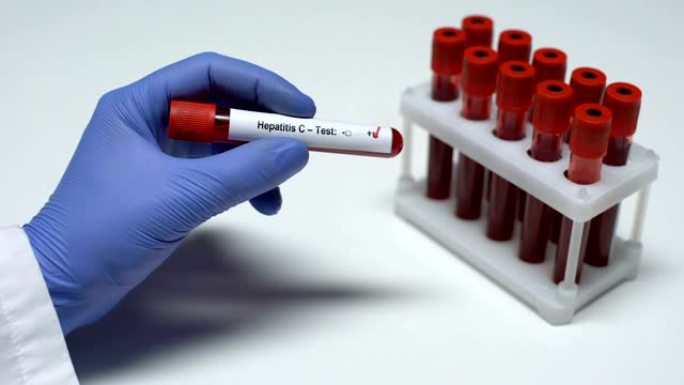 丙型肝炎检测阳性，医生在试管中显示血样，健康检查