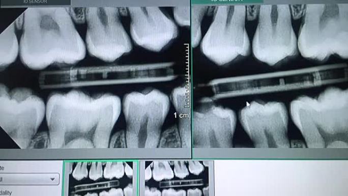 监视器上牙齿的全景x射线