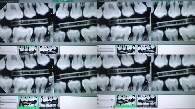 监视器上牙齿的全景x射线