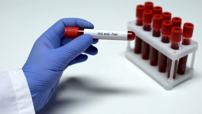 尿酸，医生在试管中显示血样，实验室研究，健康检查