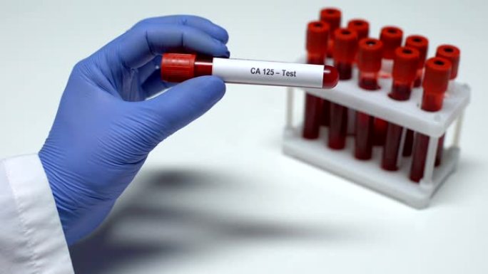 CA 125，医生在试管中显示血样，实验室研究，健康检查