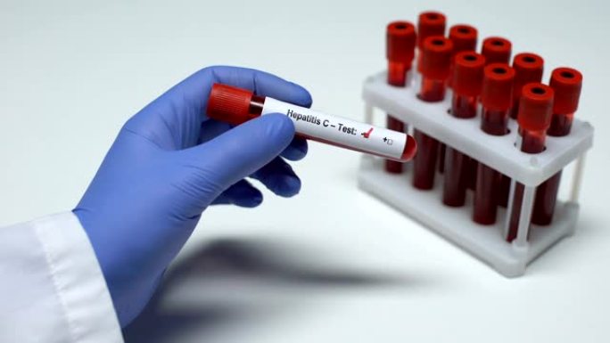 丙型肝炎检测阴性，医生在试管中显示血样，健康检查
