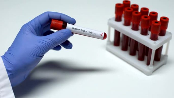蛋白质印迹试验阳性，医生在试管中显示血样，实验室研究