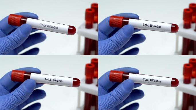 总胆红素，医生在试管中保存血液样本特写，健康检查