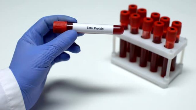 总蛋白，医生在试管中显示血样，实验室研究，健康检查