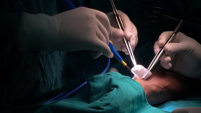 血管外科医生在手术中使用烧灼术