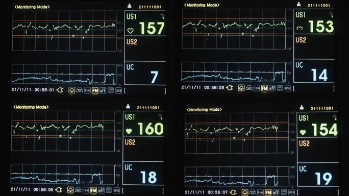 视频心血管内科ICU监护仪，患者在医院的生命体征
