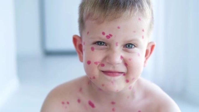 一个悲伤的男孩，脸上起了水痘疹子。在孩子的皮肤上用红色治愈霜治疗水痘。