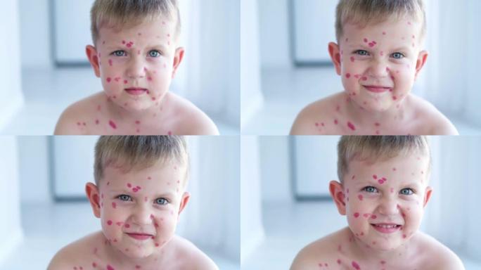 一个悲伤的男孩，脸上起了水痘疹子。在孩子的皮肤上用红色治愈霜治疗水痘。