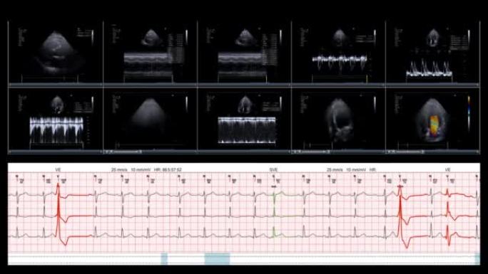 查看回声心脏显示屏经胸心动图超声屏幕在数字平板上检查心脏