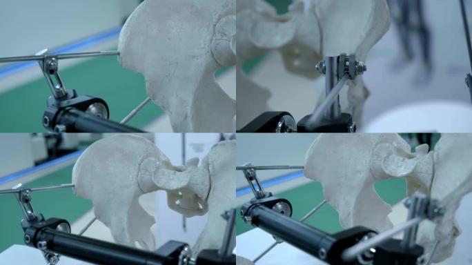 骨盆骨折、股骨颈骨折修复的高科技建议