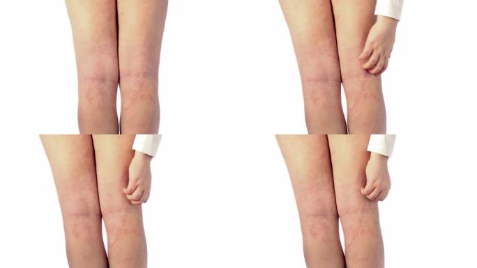 急性特应性皮炎，儿童膝盖后的腿部湿疹是皮肤的皮肤病。腿部大，红色，发炎，鳞状皮疹。患有严重特应性湿疹