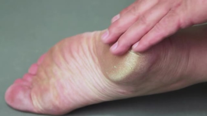 一只手在男人脚后跟角质化的皮肤上摩擦。