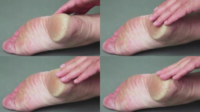 一只手在男人脚后跟角质化的皮肤上摩擦。