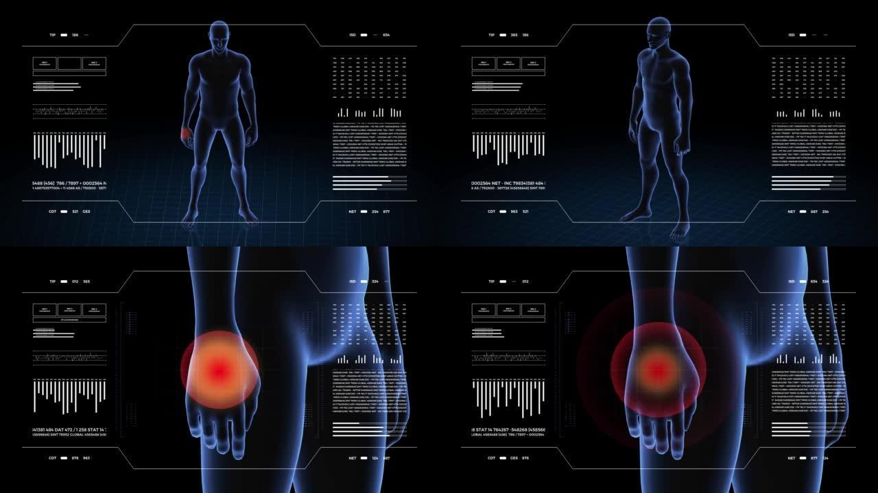 有手部病理学的人。男孩的3d身体。男性人形。