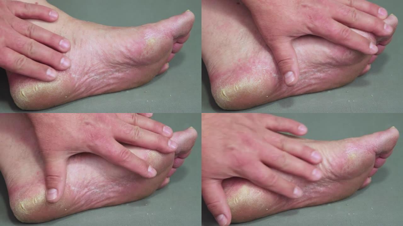 一只手在男性脚后跟角质化的脚上摩擦。