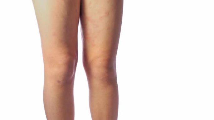 儿童膝盖后腿部的急性特应性皮炎是皮肤的皮肤病。腿部大，红色，发炎，鳞状皮疹。患有严重特应性湿疹的青少