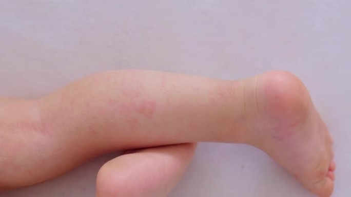 儿童腿上的过敏性皮肤，红色皮疹皮炎，特写特应性湿疹
