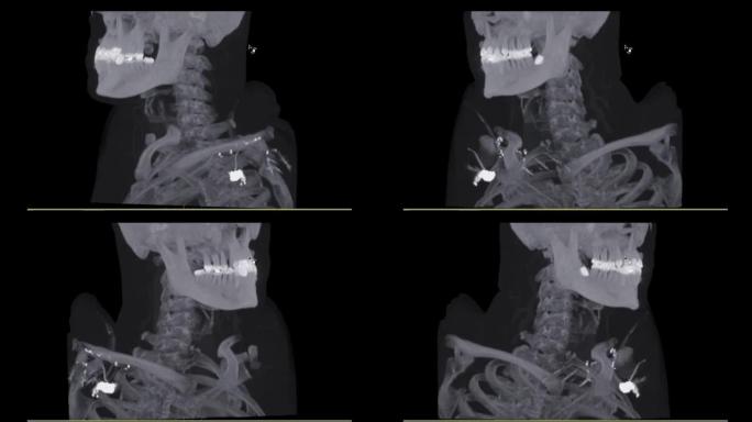 患者创伤情况下颈椎 (C脊柱) 的ct扫描。