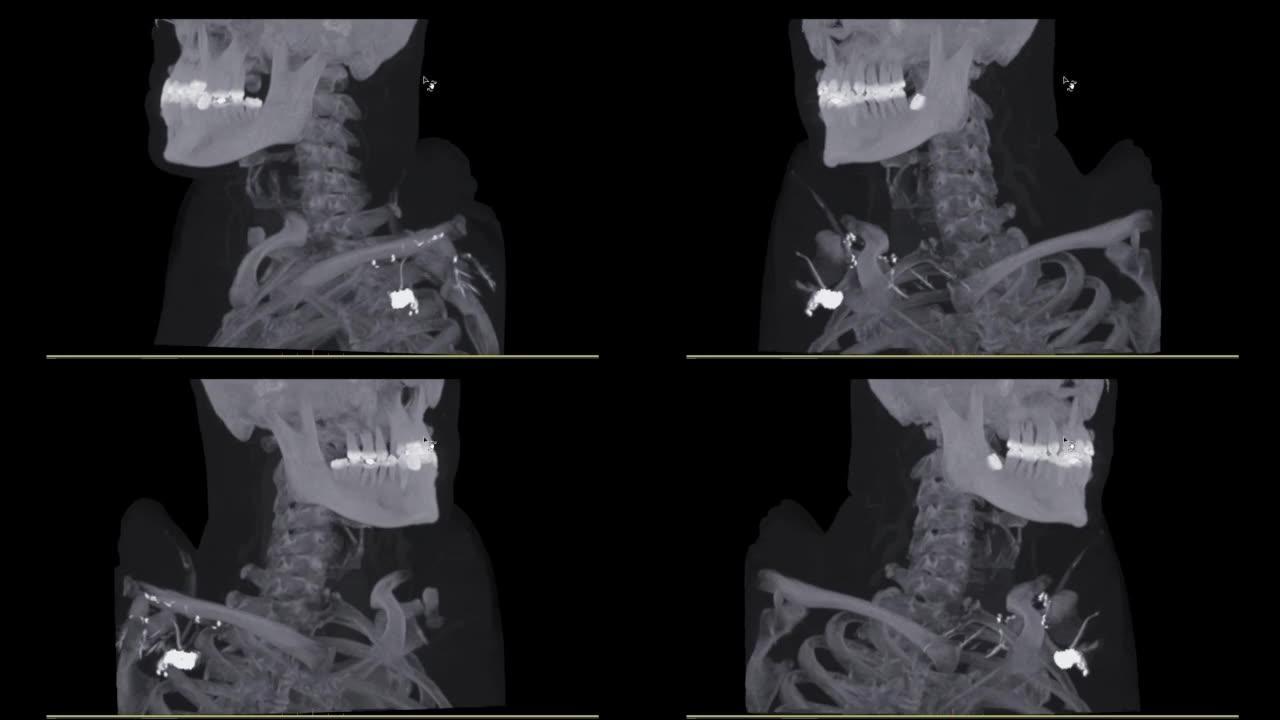 患者创伤情况下颈椎 (C脊柱) 的ct扫描。