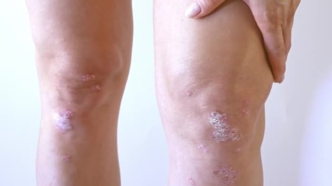 银屑病关节炎，女性膝盖上有皮肤牛皮癣。左膝关节牛皮癣患者的滑液。炎症性关节炎引起肿胀、发红、疼痛和关