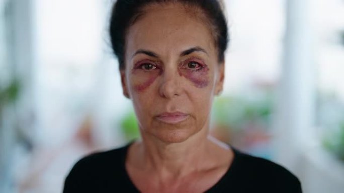 中年西班牙妇女遭受家庭暴力，眼睛上有瘀伤