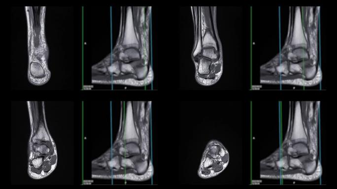 Mri踝关节。