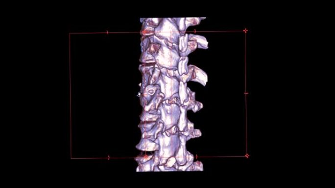 T-l脊柱或胸腰椎交界处脊柱的ct扫描3D渲染图像在屏幕上显示L1脊柱骨折。