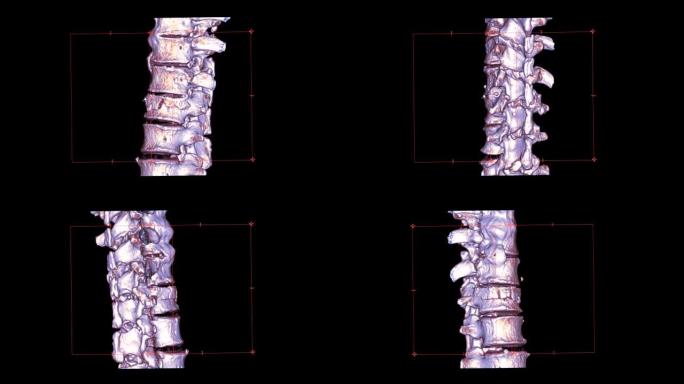 T-l脊柱或胸腰椎交界处脊柱的ct扫描3D渲染图像在屏幕上显示L1脊柱骨折。