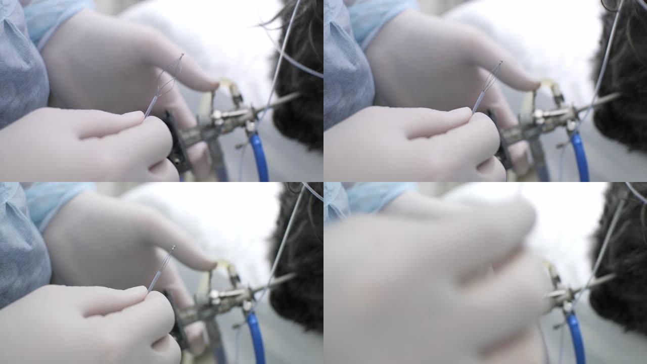 特写。兽医演示了打开内窥镜篮从器官中提取结石的机制。兽医准备内窥镜篮以去除膀胱结石。