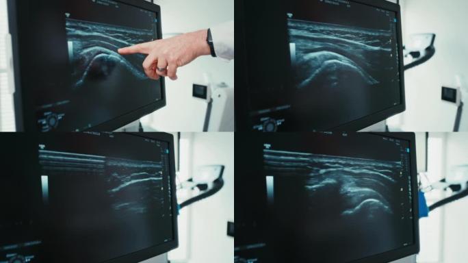 使用超声波扫描检查患者肩部受伤的物理治疗师的特写镜头。医学运动科学家双手指向并显示，以解释过度训练造