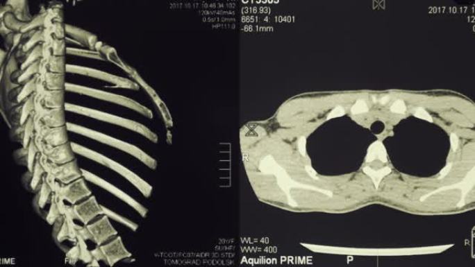 肋骨，脊柱和肺的人体胸部的磁共振成像 (MRI)