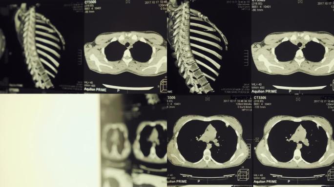 肋骨，脊柱和肺的人体胸部的磁共振成像 (MRI)